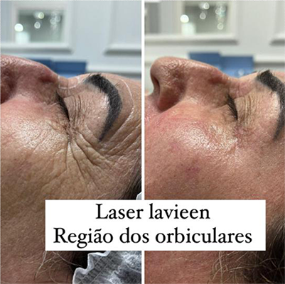 Procedimento com Laser Lavieen