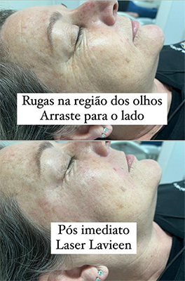 Procedimento com Laser Lavieen