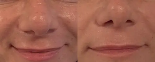 Antes e depois do procedimento ultraformer